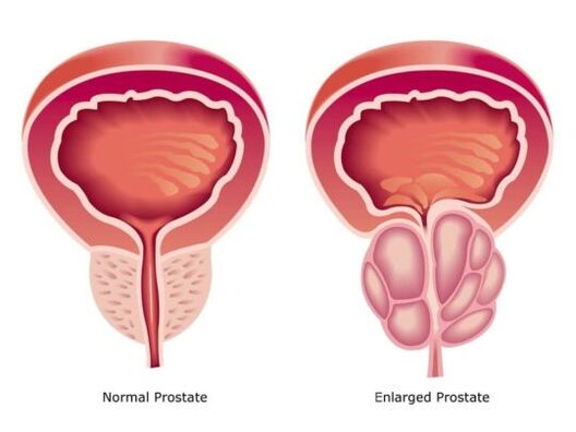 Normale und vergrößerte Prostata